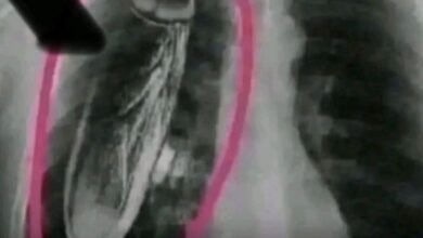 Photo of एआई जनरेटेड एक्स-रे वायरल: सोशल मीडिया पर सोलन-शिमला-बद्दी अस्पतालों की फर्जी खबर से हड़कंप