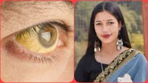 Photo of मंडी के गोहर में पीलिया का कहर: 2 की मौत, 32 एक्टिव केस; दूषित पानी पर उठे सवाल